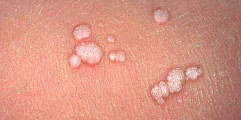 زگیل تناسلی دقیقاً چیست و چه شکلی دارد؟ (بررسی علائم ظاهری)