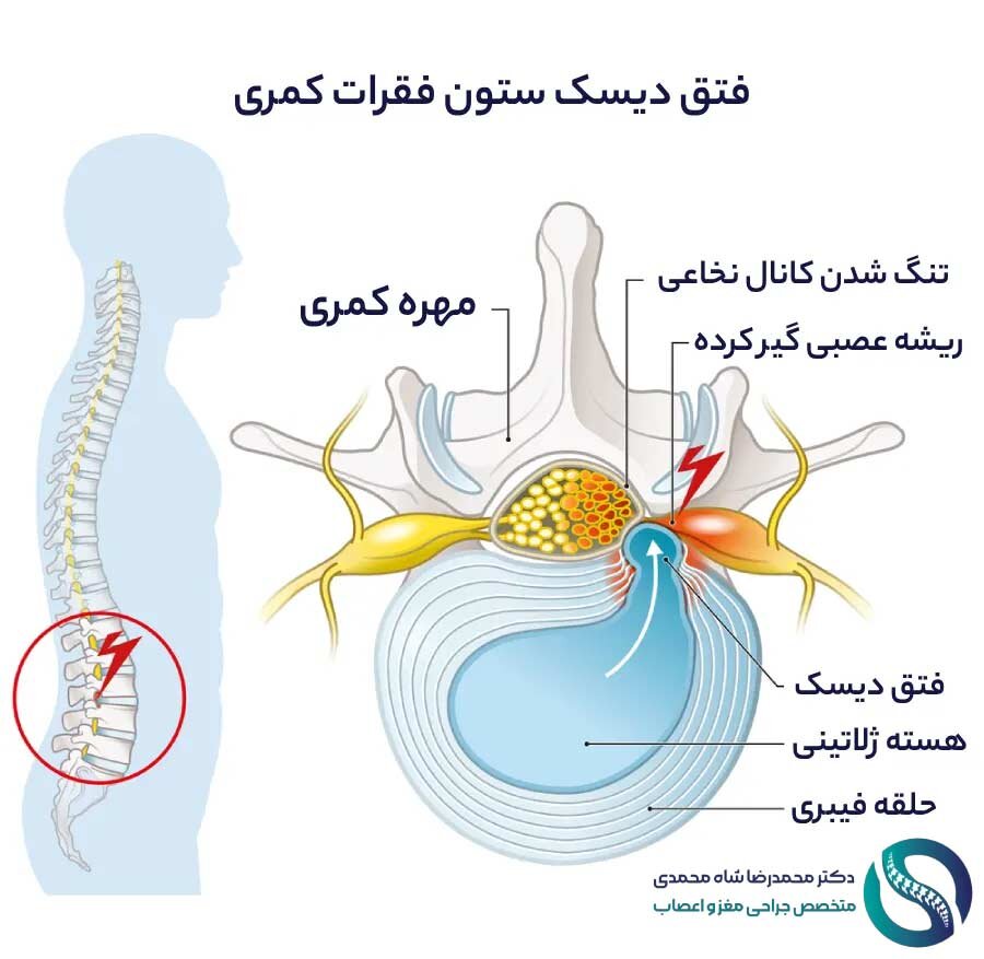 دیسک کمر - فتق دیسک کمر
