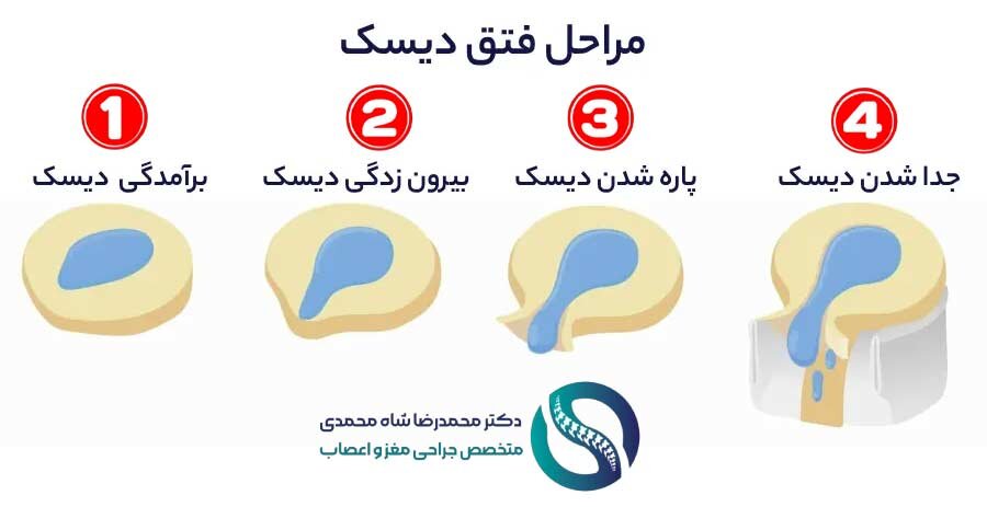 مراحل دیسک کمر - دکتر شاه محمدی جراح دیسک کمر تهران
