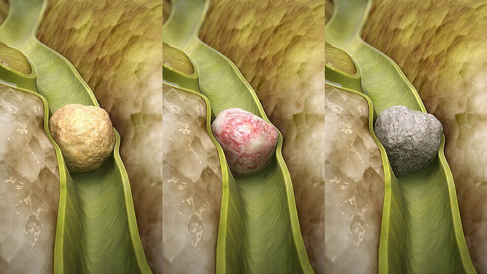 bile stone