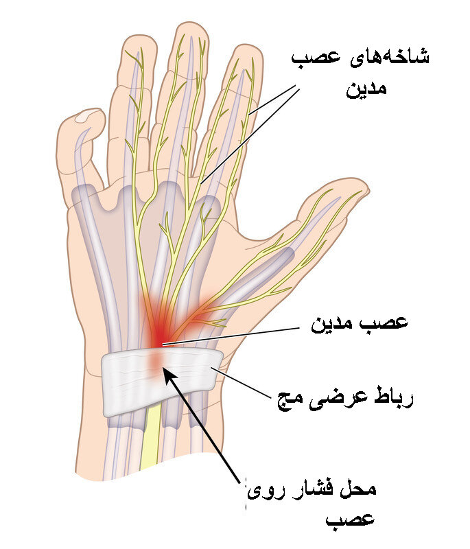 چطور درد مچ در سندرم تونل کارپال را تسکین دهیم؟