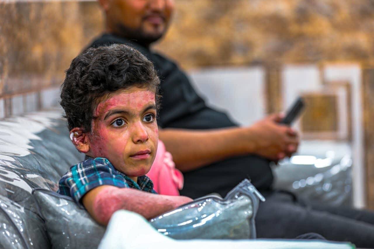 اولین تصاویر از کودک جانباز مدرسه میناب | وضعیت صورت و زخم‌های محمد شریفی را ببینید