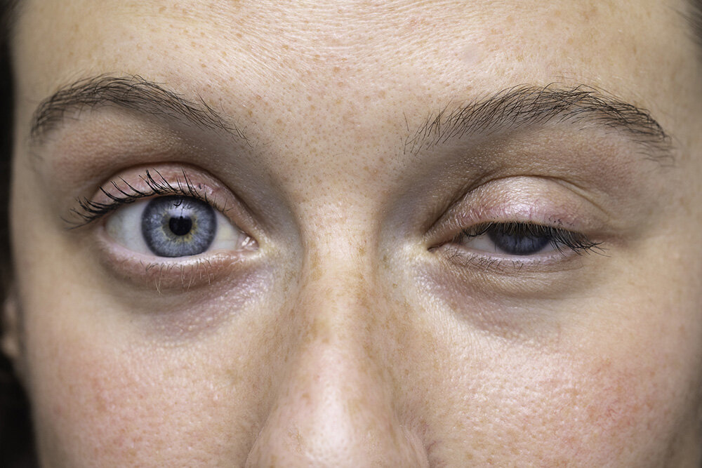 ptosis