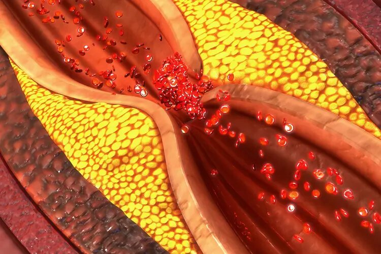 Athersclerosis