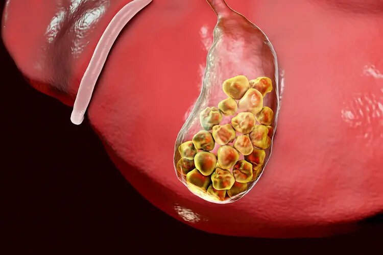 gallstone