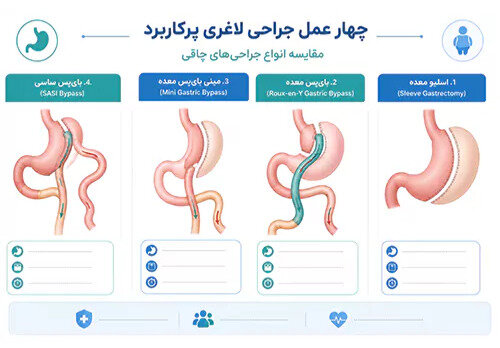 عمل معده برای لاغری