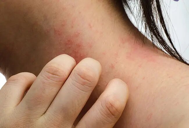 rashes