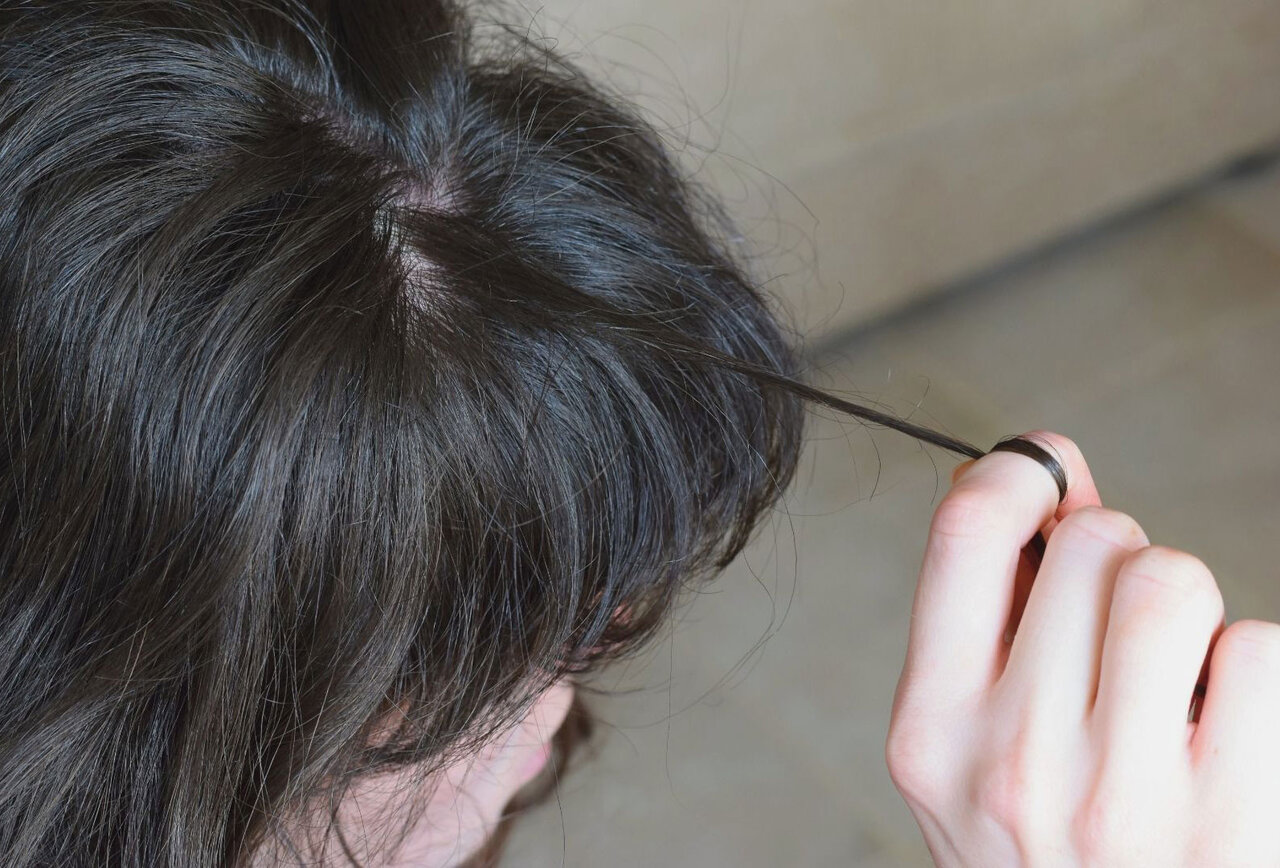 trichotillomania