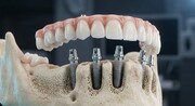 چرا روش All-on-6 به گزینه محبوب متخصصان تبدیل شده است؟