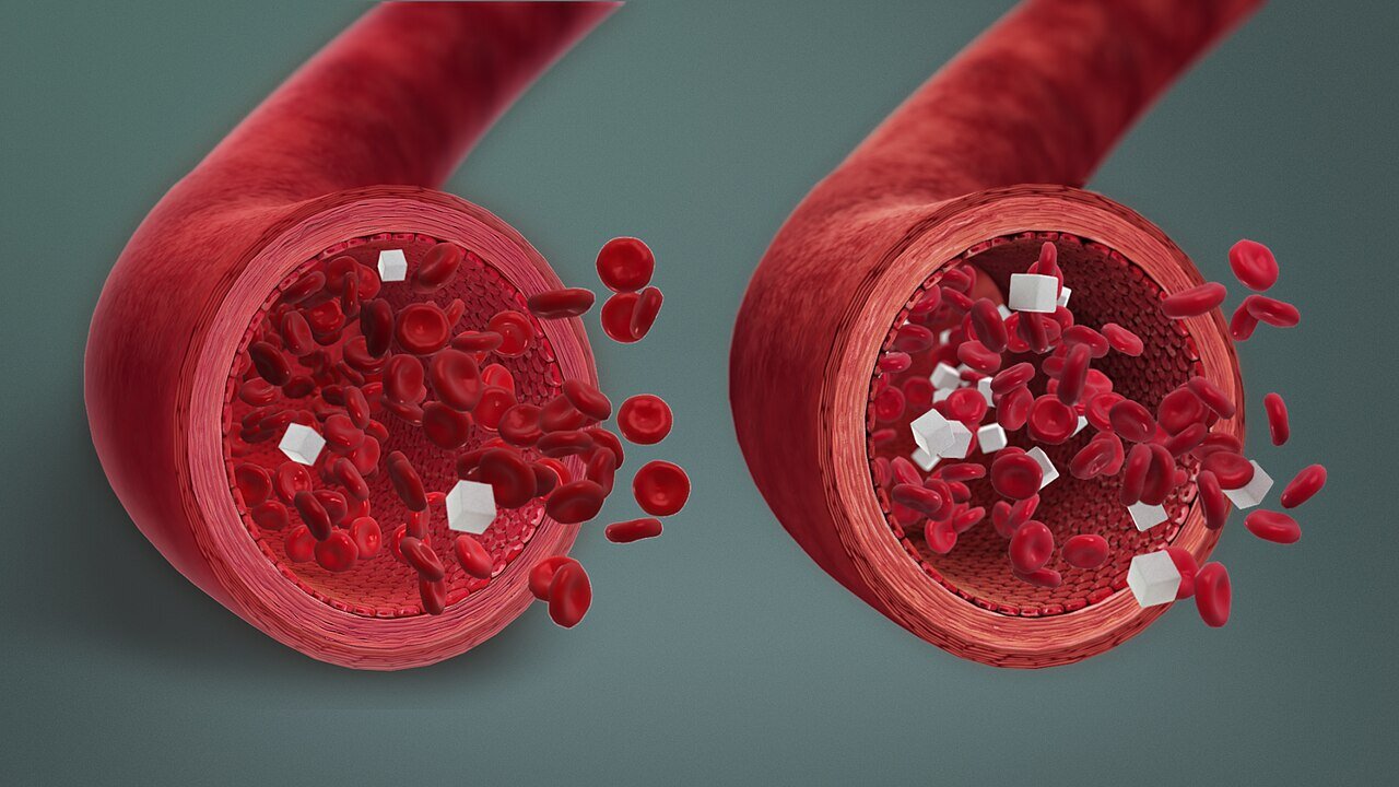 hypoglycemia