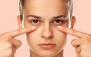 راز چشم‌های شاداب؛ چند راهکار فوری برای رفع پف زیر چشم
