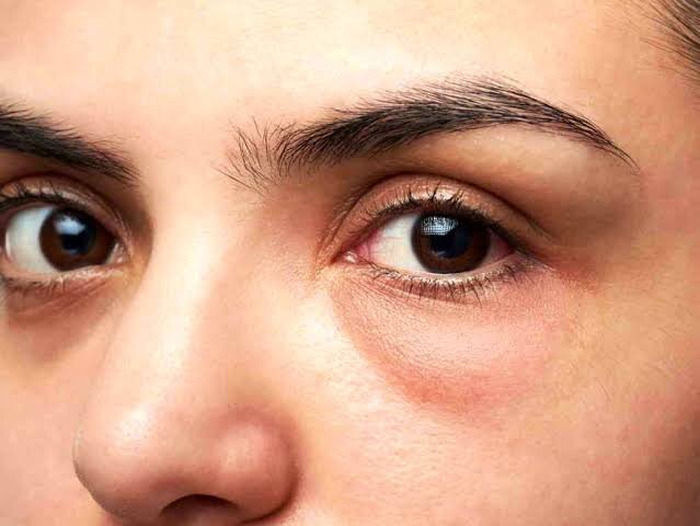 راز چشمهای شاداب؛ چند راهکار فوری برای رفع پف زیر چشم
