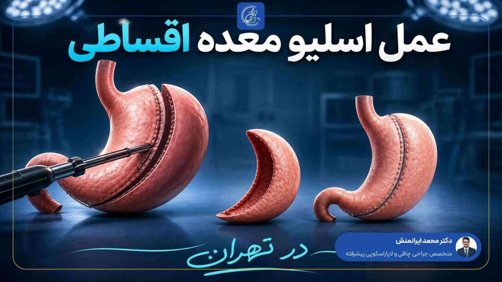 اسلیو معده اقساطی
