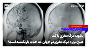 تفاوت مرگ مغزی با کما؛ هیچ مورد مرگ مغزی در جهان به حیات بازنگشته است