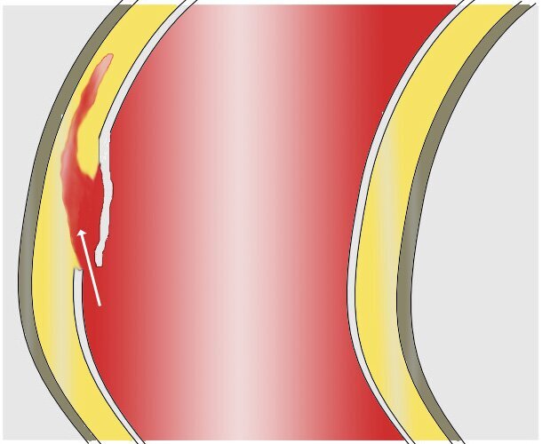 Aorta