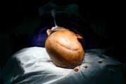 برای اولین‌بار در ایران؛ درمان موفق تومور مغزی بدخیم | تصاویر