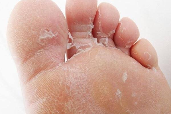 پوسته‌پوسته شدن پا نشانه چیست؟؛ ۱۰ علت شایع و راه‌های پیشگیری