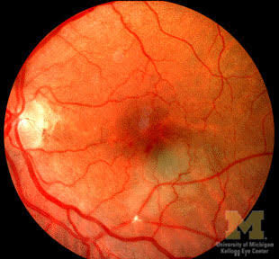 retina