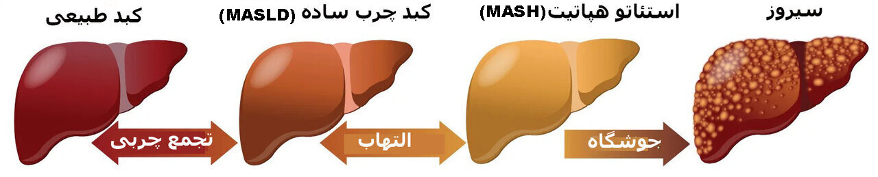 کبد چرب، کبد را پیش از ۵۰ سالگی از پا درمیآورد