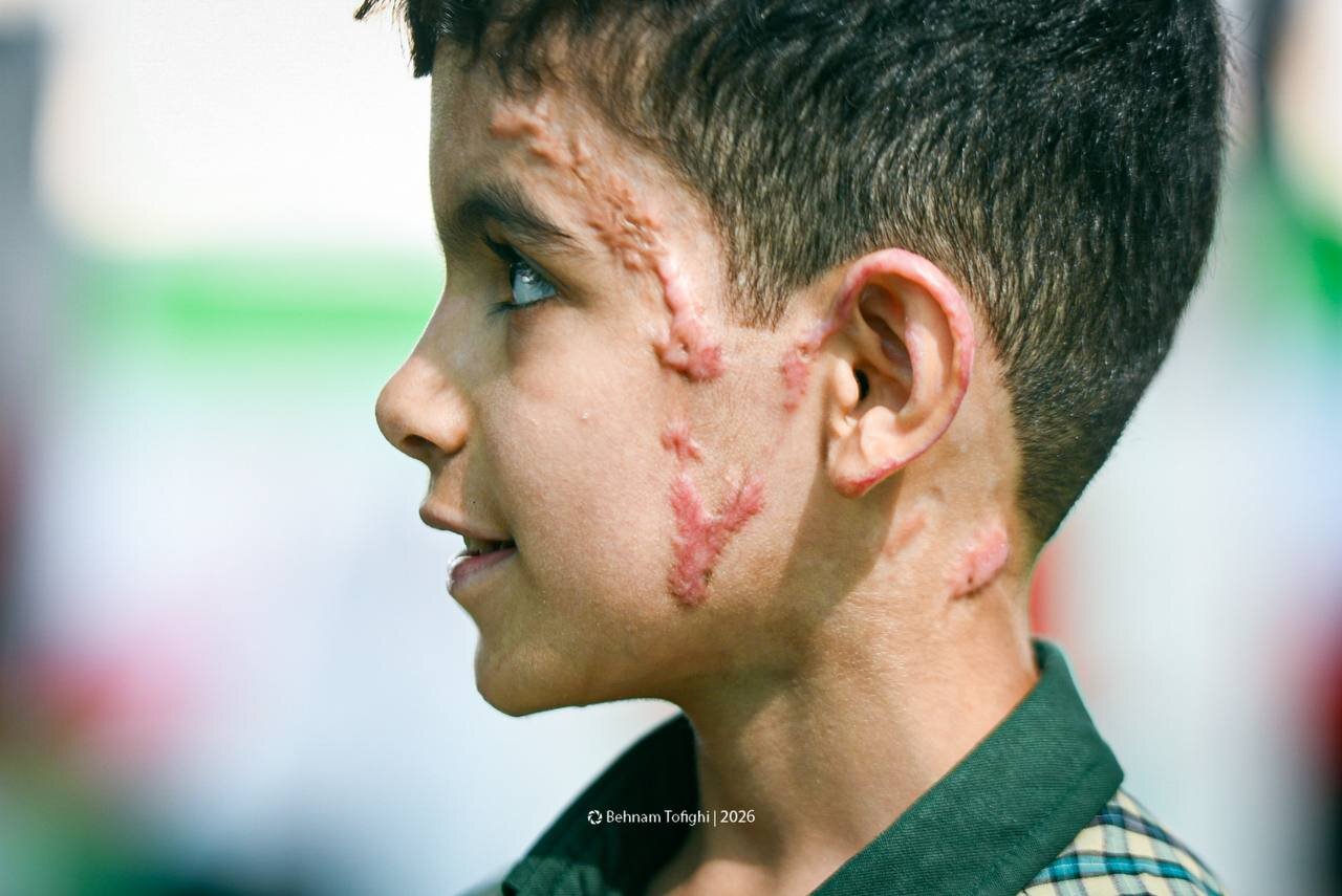 تصاویر دلخراش رد بمباران روی صورت و بدن دانشآموز مینابی