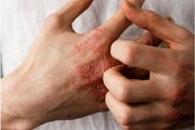 خطر همه‌گیری جهانی طاعون جدی است؟ | واکنش مهم سازمان بهداشت جهانی + ویدئو