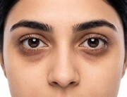 علت تیرگی و پف زیر چشم چیست؟ راهکارهای مراقبت از پوست دور چشم