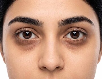 علت تیرگی و پف زیر چشم چیست؟ راهکارهای مراقبت از پوست دور چشم