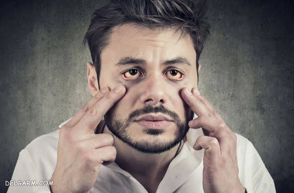 واقعا کمبود آهن را میتوان از روی چهره تشخیص داد؟ نشانههایی که باید جدی بگیرید
